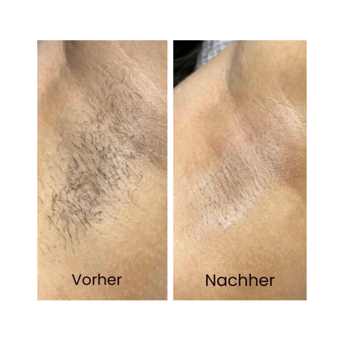 Mini Laser Shave – sanfte Laser-Haarentfernung für zu Hause, kompakt & effektiv
