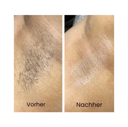 Mini Laser Shave – sanfte Laser-Haarentfernung für zu Hause, kompakt & effektiv